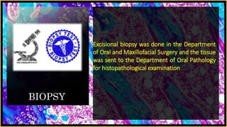 BIOPSY
Excisional biopsy was done in the Department
of Oral and Maxillofacial Surgery and the tissue
was sent to the Department of Oral Pathology
for histopathological examination
 