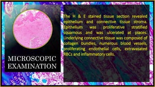 MICROSCOPIC
EXAMINATION
The H & E stained tissue section revealed
epithelium and connective tissue stroma.
Epithelium was proliferative stratified
squamous and was ulcerated at places.
Underlying connective tissue was composed of
collagen bundles, numerous blood vessels,
proliferating endothelial cells, extravasated
RBCs and inflammatory cells.
 