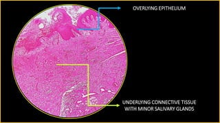 Contoso
S u i t e s
OVERLYING EPITHELIUM
UNDERLYING CONNECTIVE TISSUE
WITH MINOR SALIVARY GLANDS
 