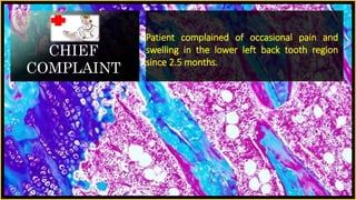 CHIEF
COMPLAINT
Patient complained of occasional pain and
swelling in the lower left back tooth region
since 2.5 months.
 