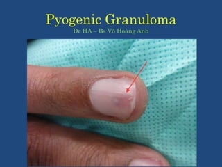 Pyogenic Granuloma
Dr HA – Bs Võ Hoàng Anh
 