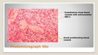 16
Small proliferating blood
vessels
Endothelium lined blood
vessels with extravasated
RBC’s
 