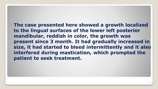  The case presented here showed a growth localized
to the lingual surfaces of the lower left posterior
mandibular, reddish in color, the growth was
present since 3 month. It had gradually increased in
size, it had started to bleed intermittently and it also
interfered during mastication, which prompted the
patient to seek treatment.
35
 