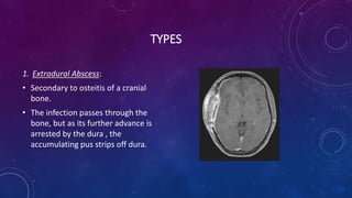 TYPES
1. Extradural Abscess:
• Secondary to osteitis of a cranial
bone.
• The infection passes through the
bone, but as its further advance is
arrested by the dura , the
accumulating pus strips off dura.
 