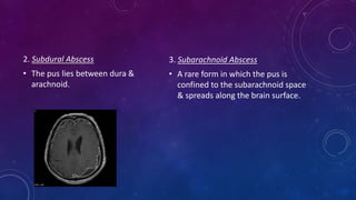 2. Subdural Abscess
• The pus lies between dura &
arachnoid.
3. Subarachnoid Abscess
• A rare form in which the pus is
confined to the subarachnoid space
& spreads along the brain surface.
 