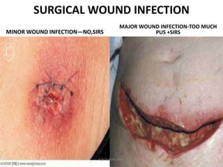 Infected Incision Example Red pyogenicinfection-220525044518-22297acd.pdf