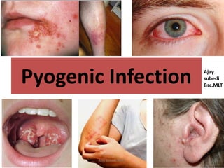 Pyogenic Infection Ajay
subedi
Bsc.MLT
Ajay Subedi,BMLT
 