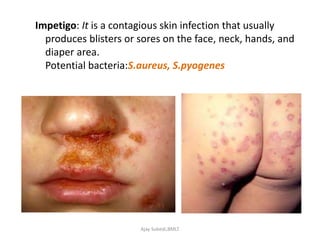 Impetigo: It is a contagious skin infection that usually
produces blisters or sores on the face, neck, hands, and
diaper area.
Potential bacteria:S.aureus, S.pyogenes
Ajay Subedi,BMLT
 