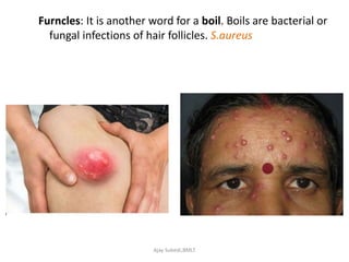 pyogenic infection.pptx