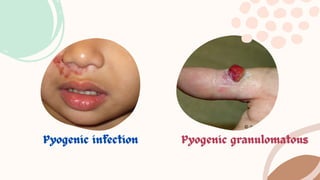 Pyogenic infection by Tharanisha.M _20240425_072415_0000.pdf