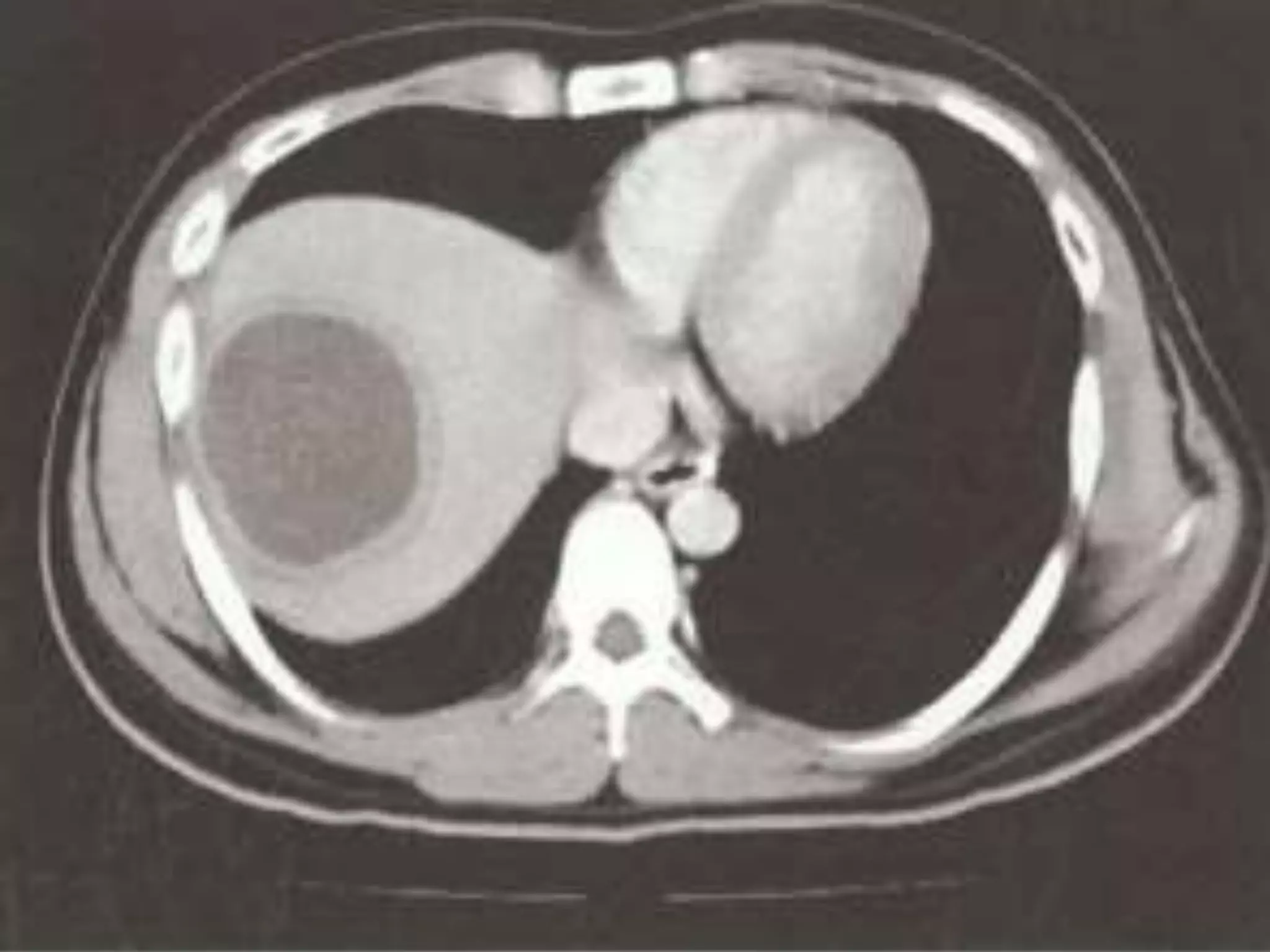 PYOGENIC LIVER ABSCESS.pptx