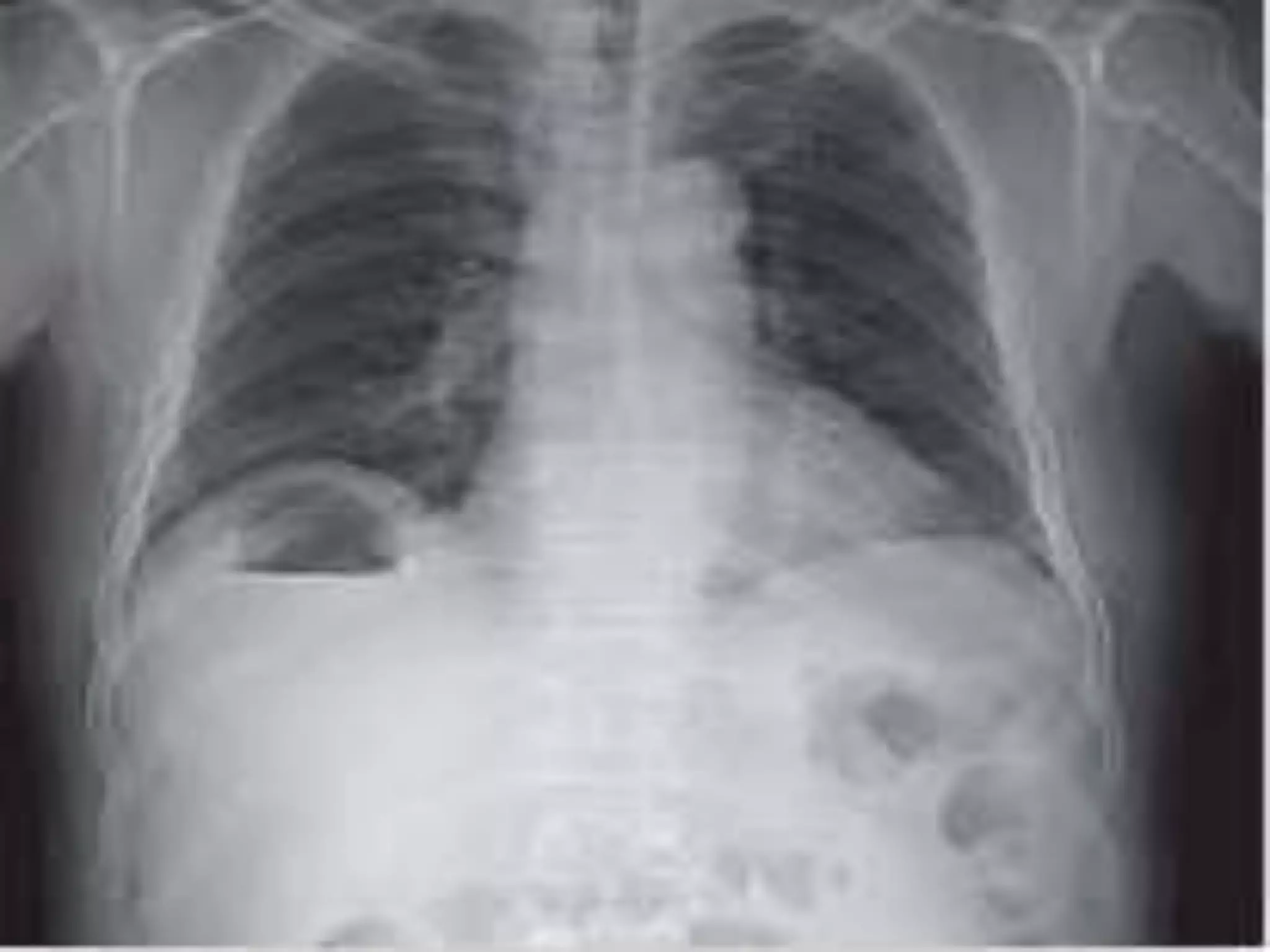 PYOGENIC LIVER ABSCESS.pptx