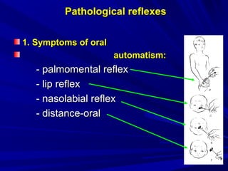 Pathological reflexesPathological reflexes
1.1. Symptoms of oralSymptoms of oral
automatism:automatism:
-- palmomental reflexpalmomental reflex
-- lip reflexlip reflex
-- nasolabial reflexnasolabial reflex
- distance-oral- distance-oral
 