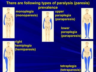 monoplegiamonoplegia
((monoparesismonoparesis))
upperupper
paraplegiaparaplegia
((paraparesisparaparesis))
lowerlower
рараraplegiaraplegia
(ра(раraparesisraparesis))
rightright
hemiplegiahemiplegia
((hemiparesishemiparesis))
tetraplegiatetraplegia
((tetraparesistetraparesis))
There are following types of paralysis (paresis)There are following types of paralysis (paresis)
prevalenceprevalence
 