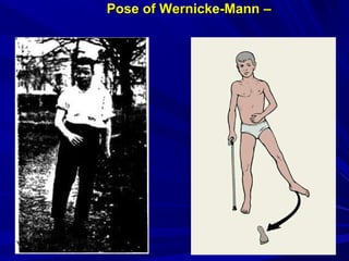 Pose of Wernicke-MannPose of Wernicke-Mann ––
 