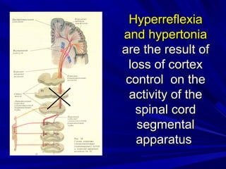HyperreflexiaHyperreflexia
and hypertoniaand hypertonia
are the result ofare the result of
loss of cortexloss of cortex
control on thecontrol on the
activity of theactivity of the
spinal cordspinal cord
segmentalsegmental
apparatusapparatus
 