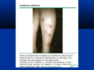 Pyrexia of unknown origin | PPT