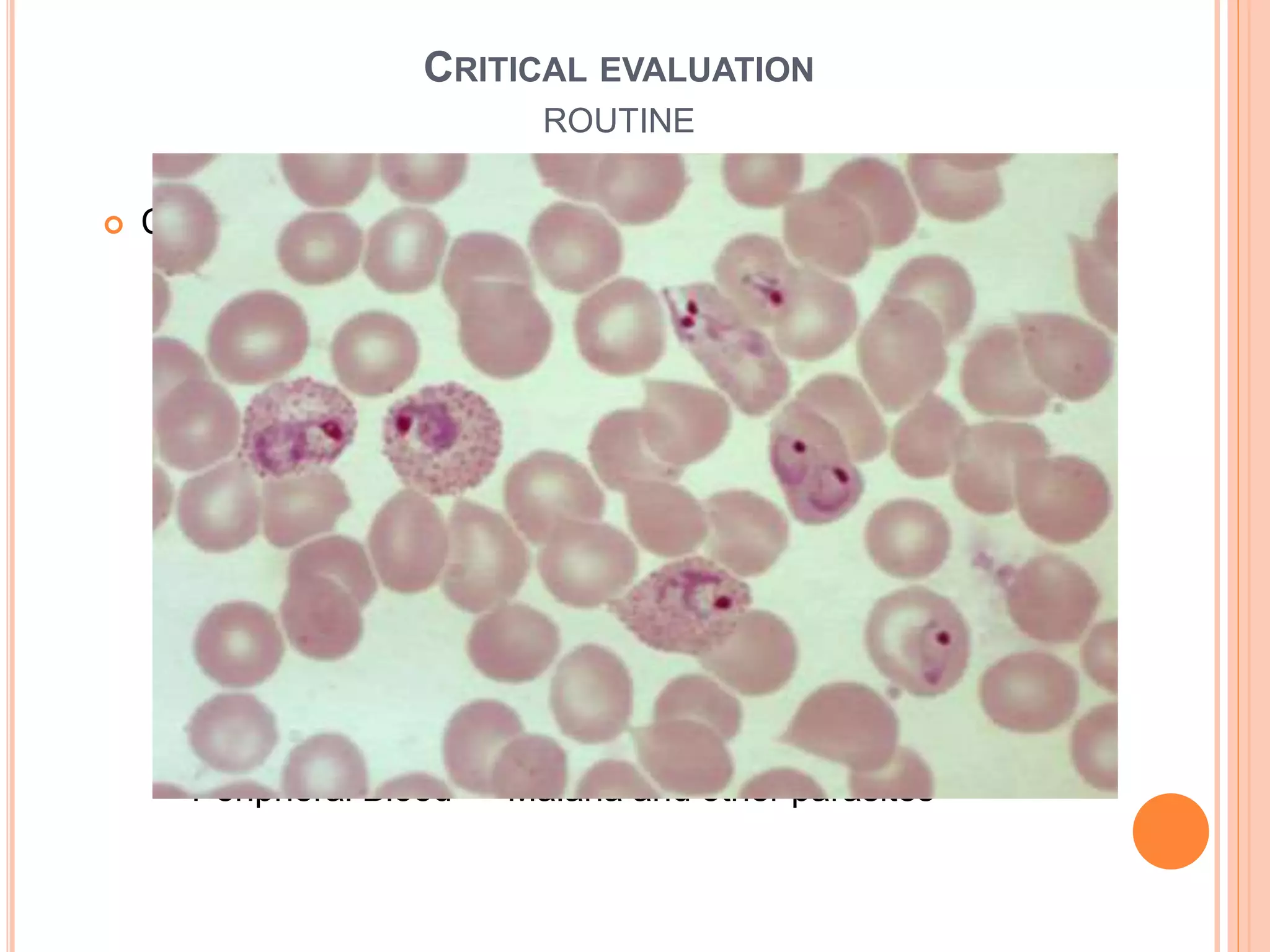  Complete Blood Count
 Anemia suggests a serious underlying disease
 Leukocytosis with bands → occult bacterial infection
 Lymphocytosis & atypical lymphocyte → Infectious
mononucleosis
 Leucopenia and lymphopenia → advanced HIV, typhoid
 Leukoerythroblastic Anemia → Disseminated TB
 Thrombocytopenia → Malaria/Leukemia
 Peripheral Blood → Malaria and other parasites
CRITICAL EVALUATION
ROUTINE
 