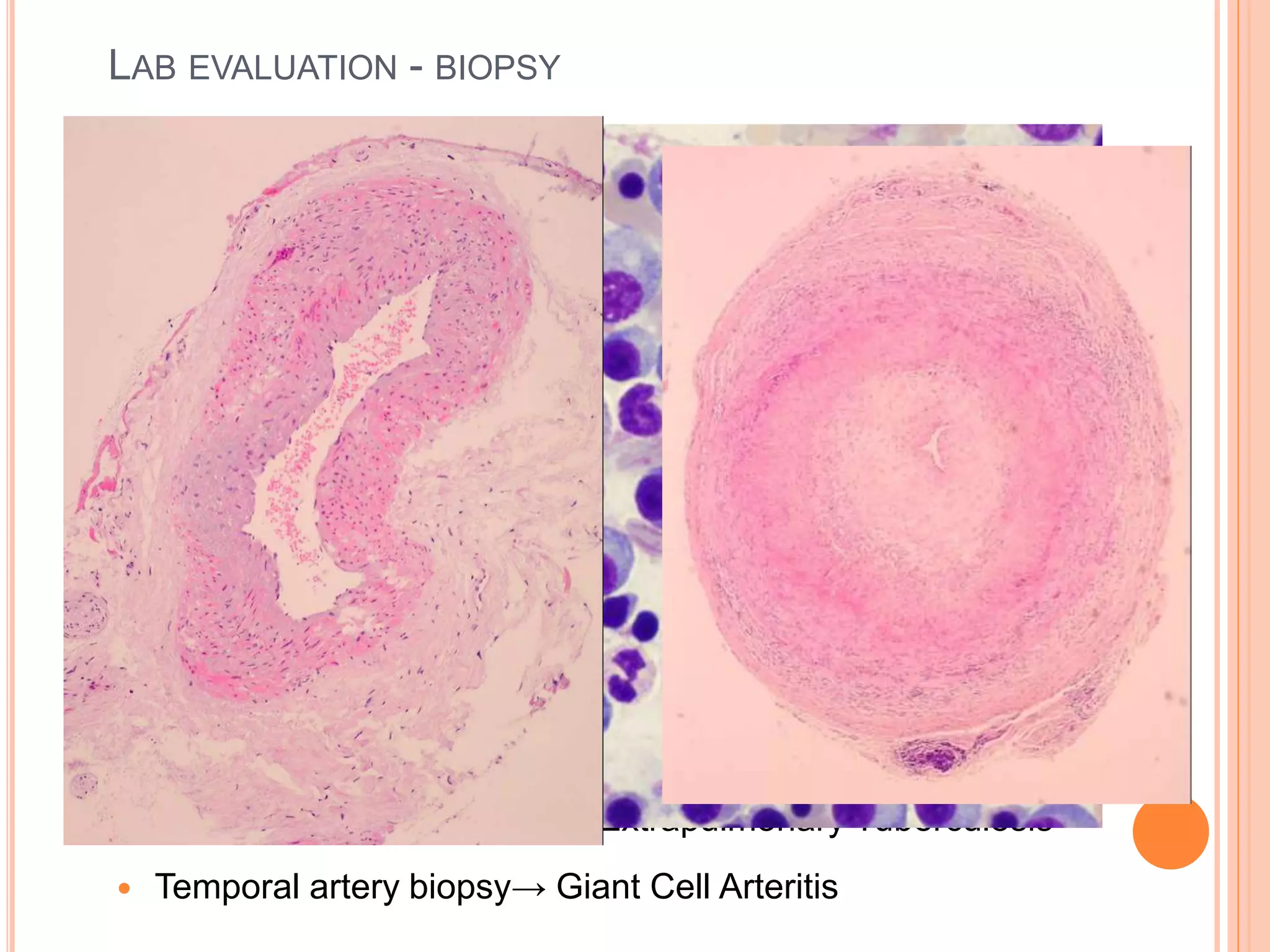  Hepatomegaly or Abnormal LFT
 Hepatic Granuloma
 Non-caseating: Tuberculosis/Sarcoidosis & Brucellosis
 Caseating: Tuberculosis
 Bone Marrow
 Granuloma ± Tubercle Bacilli → Tuberculosis
 Aplastic Cells → Leukemia
 Leishmania Bodies → Kala-Azar
 Atypical Cells → Lymphoma
 Atypical Plasma Cells → Multiple myeloma
 Pleural or pericardial fluid→ Extrapulmonary Tuberculosis
 Temporal artery biopsy→ Giant Cell Arteritis
LAB EVALUATION - BIOPSY
 