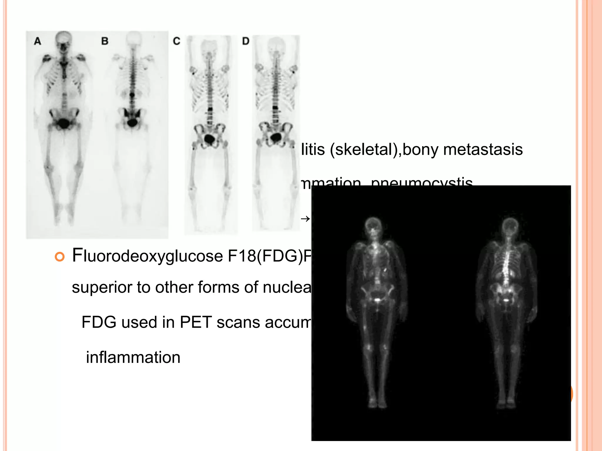 Radionuclear Scanning
 Bone TC-scan → osteomyelitis (skeletal),bony metastasis
 Gallium scan → occult inflammation, pneumocystis
 Indium labeled WBC-scan → occult abscesses
 Fluorodeoxyglucose F18(FDG)PET scanning appears to be
superior to other forms of nuclear imaging
FDG used in PET scans accumulates in tumour and at sites of
inflammation
NEWER TECHNIQUES
 