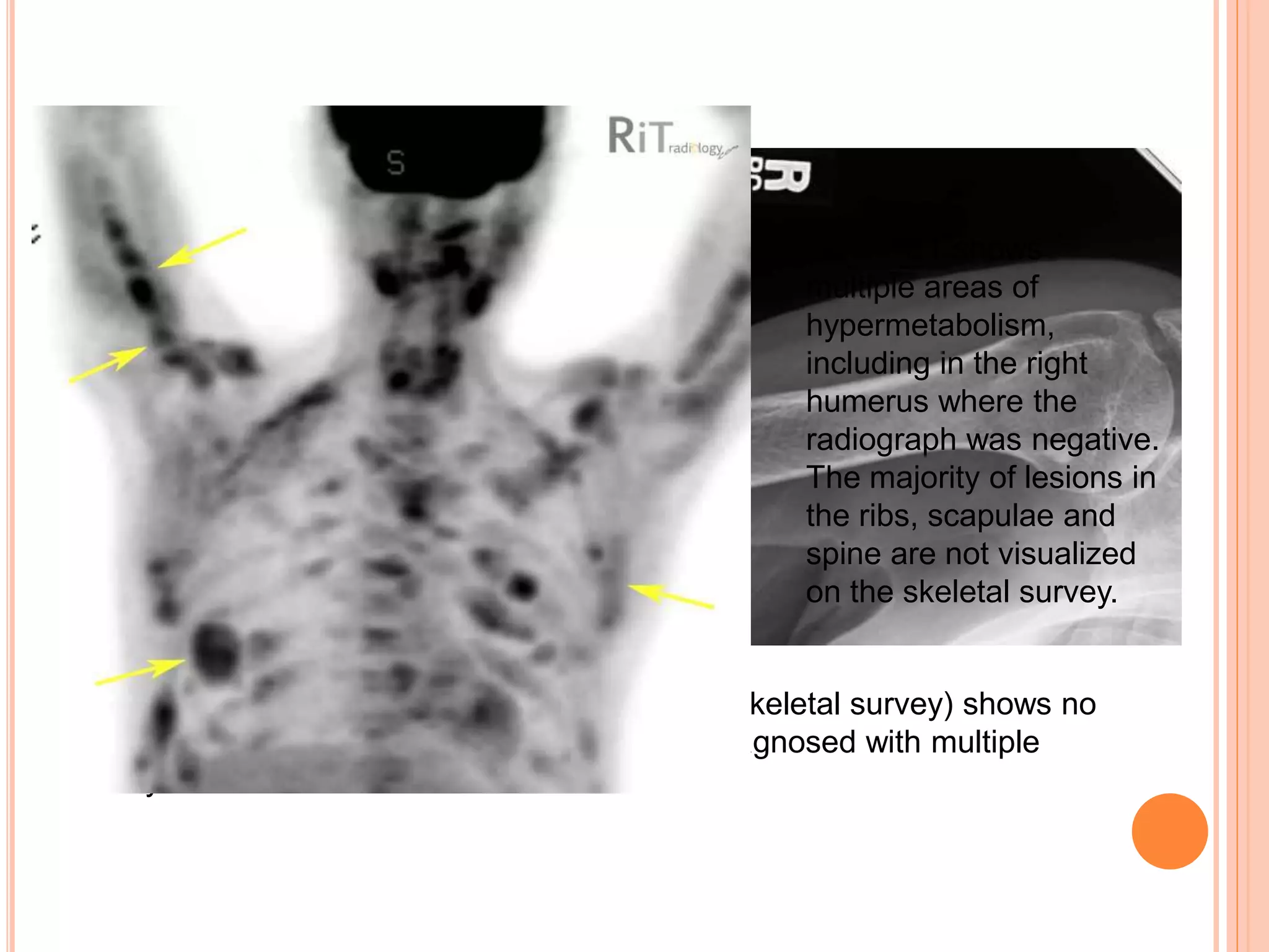 A radiograph of the right humerus (a part of skeletal survey) shows no
abnormality in a 69-year-old man recently diagnosed with multiple
myeloma.
FDG-PET shows
multiple areas of
hypermetabolism,
including in the right
humerus where the
radiograph was negative.
The majority of lesions in
the ribs, scapulae and
spine are not visualized
on the skeletal survey.
 