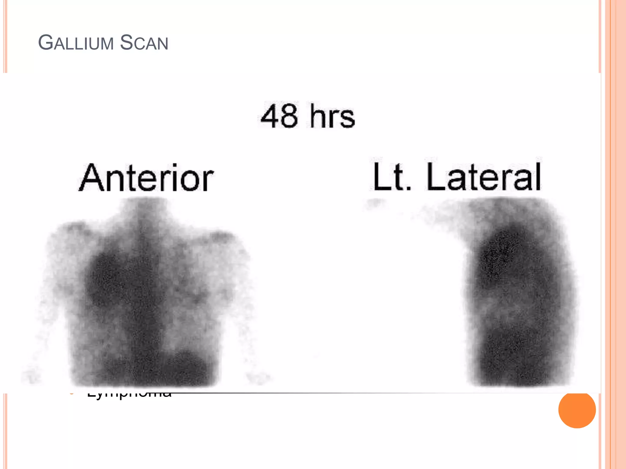GALLIUM SCAN
 Will be hot if there is:
 Increased blood flow
 Uptake by bacteria (lactoferrin)
 Uptake by WBC
 Sensitive but not specific
 Not recommended for abdomen or pelvis: false +ves are common
 Effective in:
 Chronic Infection
 Lymphoma
 