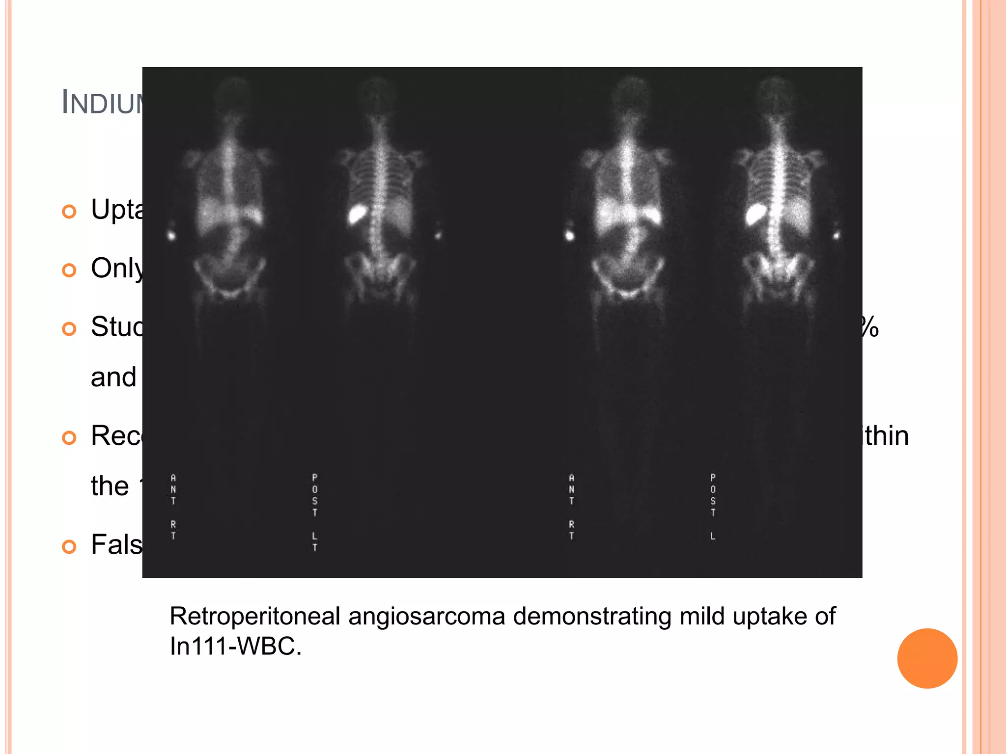 INDIUM-LABELED LEUKOCYTE
 Uptake by WBC
 Only for acute problem (less than 4 weeks)
 Study in the UK has found the sensitivity for infective PUO: 25%
and specificity was 100%
 Recommended for strongly suspected infective PUO if done within
the 1st 2-4 weeks
 False positive: post op wound, mastitis
Retroperitoneal angiosarcoma demonstrating mild uptake of
In111-WBC.
 