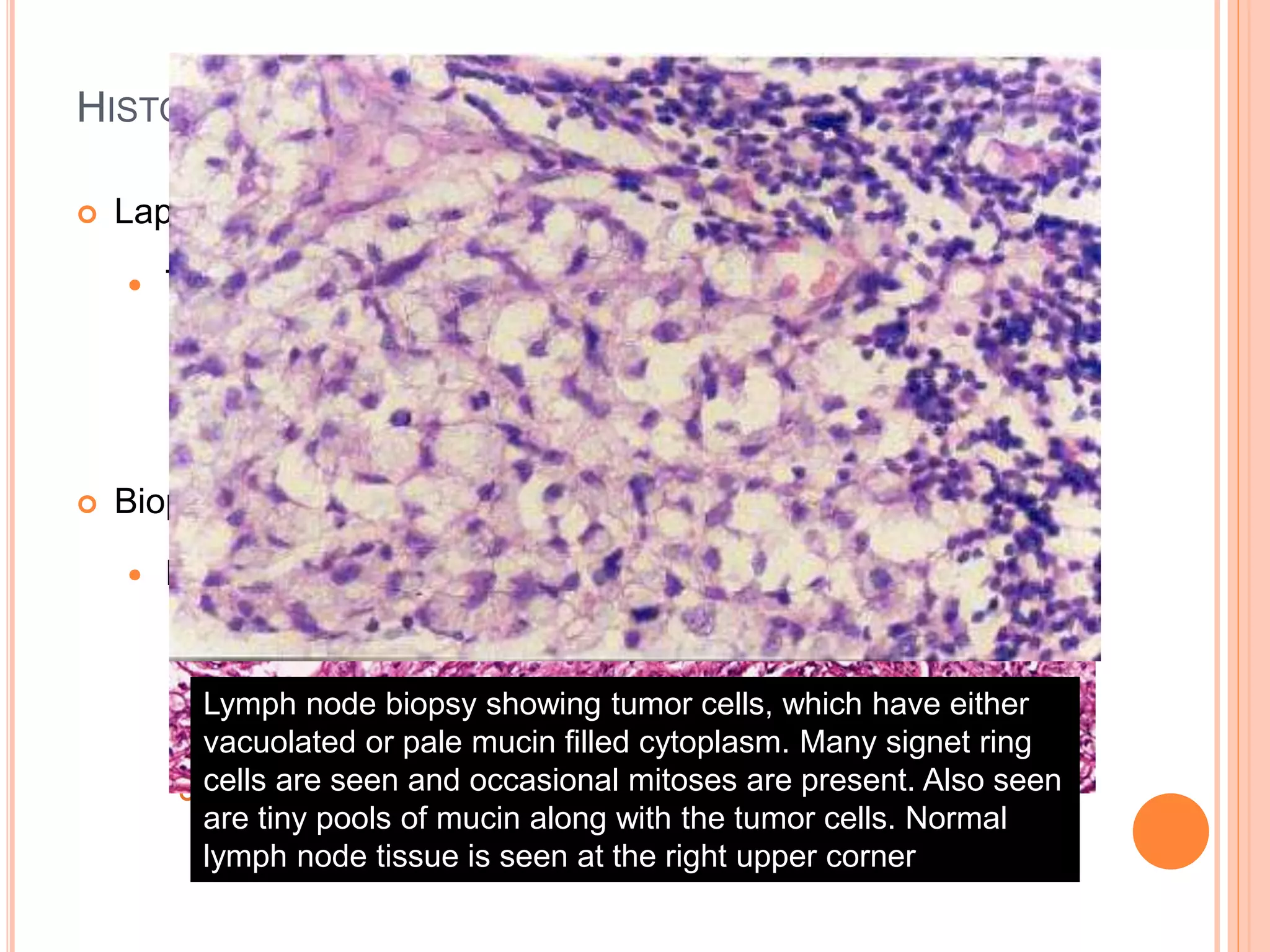  Laparoscopy
 To visualize and biopsy the pathology in the abdomen
e.g. Tuberculous peritonitis
Peritoneal carcinomatosis
 Biopsy
 Enlarged lymph node
 Granulomatous disease (Tuberculosis)
 Others
 Metastatic carcinoma
HISTOPATHOLOGICAL EVALUATION
Lymph node biopsy showing tumor cells, which have either
vacuolated or pale mucin filled cytoplasm. Many signet ring
cells are seen and occasional mitoses are present. Also seen
are tiny pools of mucin along with the tumor cells. Normal
lymph node tissue is seen at the right upper corner
 