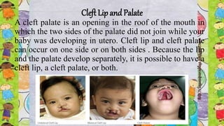 Cleft Lip and Palate
A cleft palate is an opening in the roof of the mouth in
which the two sides of the palate did not join while your
baby was developing in utero. Cleft lip and cleft palate
can occur on one side or on both sides . Because the lip
and the palate develop separately, it is possible to have a
cleft lip, a cleft palate, or both.
 