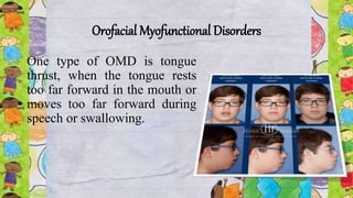 Orofacial Myofunctional Disorders
One type of OMD is tongue
thrust, when the tongue rests
too far forward in the mouth or
moves too far forward during
speech or swallowing.
 