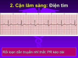 2. Cận lâm sàng:2. Cận lâm sàng: Điện timĐiện tim
Rối loạn dẫn truyền nhĩ thất: PR kéo dàiRối loạn dẫn truyền nhĩ thất: PR kéo dài
 