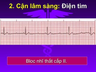 2. Cận lâm sàng:2. Cận lâm sàng: Điện timĐiện tim
Bloc nhĩ thất cấp II.Bloc nhĩ thất cấp II.
 