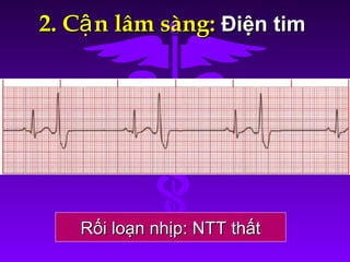 2. C n lâm sàng:ậ2. C n lâm sàng:ậ Điện timĐiện tim
Rối loạn nhịp: NTT thấtRối loạn nhịp: NTT thất
 