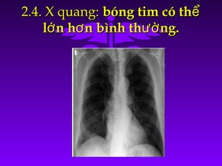 2.4. X quang:2.4. X quang: bóng tim có thểbóng tim có thể
l n h n bình th ng.ớ ơ ườl n h n bình th ng.ớ ơ ườ
 