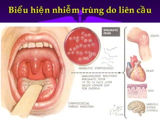 Bi u hi n nhi m trùng do liên c uể ệ ễ ầBi u hi n nhi m trùng do liên c uể ệ ễ ầ
 