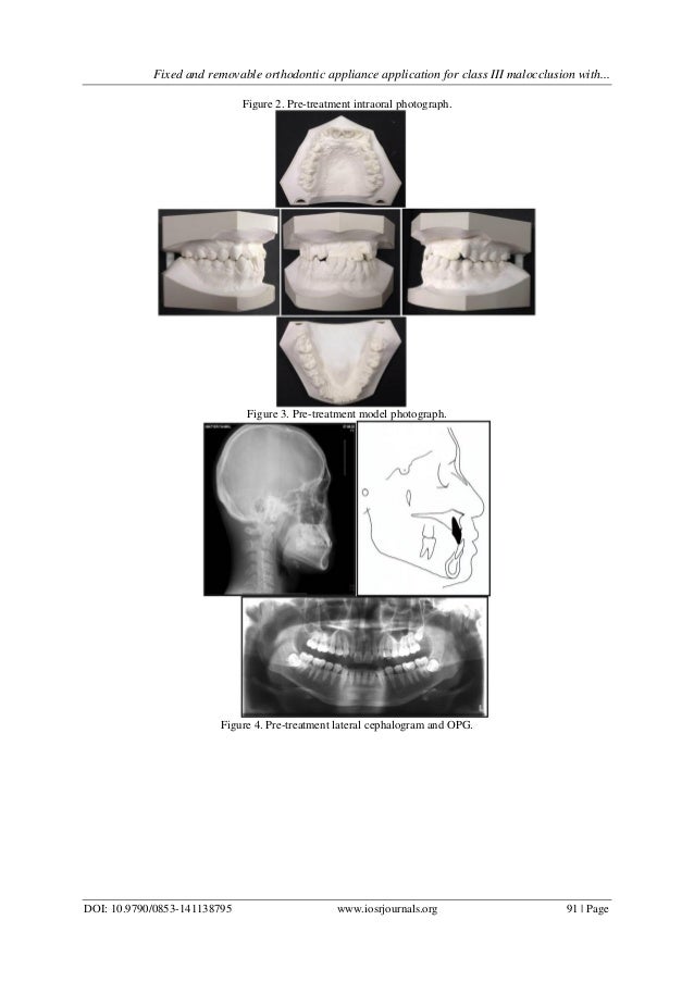 Fixed and removable orthodontic appliance application for class III m…