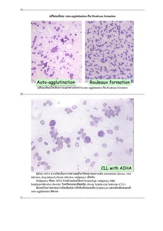 19.------------------------------------------------------------------------------------------------------------------
เปรียบเทียบ Auto-agglutination กับ Rouleaux formation
เปรียบเทียบใหเห็นความแตกตางระหวาง auto-agglutination กับ Rouleaux formation
20.------------------------------------------------------------------------------------------------------------------
ผูปวย AIHA อาจเกิดเนื่องจากสาเหตุอื่นๆไดหลายอยางเชน autoimmune disease, viral
infection, drug induced,chronic infection, malignancy เปนตน
Malignancy ที่พบ AIHA รวมดวยบอยไดแกhematologic malignancy กลุม
lymphoproliferative disorder โรคที่พบบอยที่สุดคือ chronic lymphocytic leukemia (CLL)
สังเกตในภาพจะพบวาเม็ดเลือดขาวที่เห็นทั้งหมดเปน lymphocyte และเม็ดเลือดแดงมี
auto-agglutination ชัดเจน
21.------------------------------------------------------------------------------------------------------------------
 