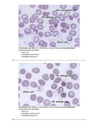 ภาพขยายของ slide ผูปวย G-6-PD deficiency with acute hemolysis แสดงเซลลลักษณะ
จําเพาะในภาวะนี้3 แบบ ไดแก
- Ghost cell
- Hemoglobin contracted cell
- Hemoglobin leakage cell
25.------------------------------------------------------------------------------------------------------------------
ภาพขยายของ slide ผูปวย G-6-PD deficiency with acute hemolysis แสดงเซลลลักษณะ
จําเพาะในภาวะนี้3 แบบ ไดแก
- Ghost cell
- Hemoglobin contracted cell
- Hemoglobin leakage cell
26.------------------------------------------------------------------------------------------------------------------
 
