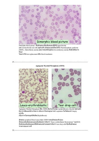 Dimorphic blood picture : คือลักษณะเม็ดเลือดแดงที่มีทั้ง hypochromia
และ normochromia red cells อยูดวยกัน ลักษณะเชนนี้พบไดใน Myelodysplastic syndrome
(MDS) , Sideroblastic anemia แตอาจพบไดในผูปวย Iron deficiency anemia ที่เพิ่งไดรับการ
รักษา
โดยการใหiron replacement หรือ blood transfusion
29.------------------------------------------------------------------------------------------------------------------
Agnogenic Myeloid Metaplasia (AMM)
Agnogenic Myeloid Metaplasia หรือ AMM เปนโรคในกลุม myelproliferative disorder ผูปวยมัก
มีอาการซีดและมีมามโตมาก เมื่อเจาะไขกระดูกอาจทํา aspiration ไมไดตองทํา biopsy
เทานั้น
เนื่องจากไขกระดูกมีพังผืด(Myelofibrosis)
ลักษณะ peripheral blood smear ของ AMM จะพบลักษณะตัวออน
ทั้งของเม็ดเลือดแดงและเม็ดเลือดขาวเรียกวา “leuco-erythroblastic blood picture” นอกจาก
นั้นยังพบเม็ดเลือดแดงที่มีลักษณะคลายหยดนํ้าเรียกวา tear drop cells ซึ่งเปนลักษณะ
จําเพาะของภาวะนี้
30.------------------------------------------------------------------------------------------------------------------
 