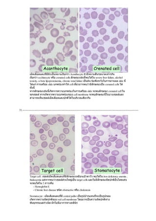 เม็ดเลือดแดงที่มีผิวเปนหนามเรียกวา Acanthocyte ถามีหนามสั้นๆขนาดเทาๆกัน
เรียกวา ecchinocyte หรือ crenated cells ลักษณะเชนนี้พบไดใน severe liver failure, alcohol
toxicity, a-beta lipoproteinemia, chronic renal failure เปนตน ขอพึงระวังในการอานผล slide นี้
ไดแกการเตรียม slide บกพรองทําใหcell เหี่ยวอาจพบวามีลักษณะเปน crenated cells ได
ทั้งนี้
หากลักษณะเชนนี้เกิดจากความบกพรองในการเตรียม slide จะพบลักษณะ crenated cell ใน
ทุกเซลลหากเกิดจากความบกพรองของ cell membrane จะพบลักษณะนี้ในบางเซลลและ
สามารถเห็นเซลลเม็ดเลือดแดงปกติไดในบริเวณเดียวกัน
31.------------------------------------------------------------------------------------------------------------------
Target cell : เซลลเม็ดเลือดแดงที่มีลักษณะเหมือนเปาตาวัว พบไดใน iron deficiency anemia ,
thalassemia แตหากพบวาเซลลสวนใหญเปน target cells และไมมีลักษณะผิดปกติอื่นโดดเดน
จะพบไดใน 2 ภาวะคือ
- Hemoglobin E
- Chronic liver disease ชนิด obstructive หรือ cholestesis
Stomatocyte : เม็ดเลือดแดงที่มีcentral pallor เปนรูปปากแทนที่จะเปนรูปกลม
เกิดจากความผิดปกติของ red cell membrane โดยมากเปนความผิดปกติทาง
พันธุกรรมแตกําเนิด มักไมมีอาการทางคลินิก
 