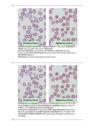 32.------------------------------------------------------------------------------------------------------------------
เม็ดเลือดแดงที่มีรูปรางผิดปกติที่เห็น กรณีมีรูปทรงรีเรียกวา “ovalocytosis” กรณีเซลลสวน
ใหญเปน spherocyte เรียก “spherocytosis” ทั้งสองกรณี
เกิดจากความผิดปกติของ cell membrane แตกําเนิดเนื่องจากพันธุกรรม Hereditary
Ovalocyosis ถายทอดทางพันธุกรรมแบบ autosomal dominant สวน Hereditary Spherocytosis
มีทั้งชนิดที่ถายทอดทาง
พันธุกรรมแบบ autosomal dominant และ autosomal recessive
33.------------------------------------------------------------------------------------------------------------------
ในการประเมินจํานวนเม็ดเลือดขาวจาก blood smear ใชการดูดวย Objective lens (40 x) นับ
จํานวนเม็ดเลือดขาวแลวหาคาเฉลี่ยวามีเม็ดเลือดขาวเฉลี่ยกี่เซลล/high power fields. นํา
คาที่ไดx 1,500 จะไดคาโดยประมาณของเม็ดเลือดขาว
การประเมินจํานวนเกร็ดเลือดจาก blood smear ใชวิธีการเดียวกันแตเปลี่ยนจาก lens (40 x)
เปน (100 x) และเปลี่ยนจํานวนเลขที่นําไปคูณกับคาเฉลี่ยที่นับไดจาก 1,500 เปน 15,000
แทนเม็ดเลือดขาวที่เห็นสวนใหญเปน PMN segmented form มีlymphocyte และ Monocyte
จํานวนนอย
34.------------------------------------------------------------------------------------------------------------------
 