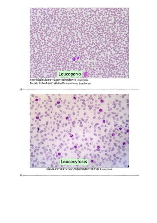 ภาวะที่มีเม็ดเลือดขาวนอยกวาปกติเรียกวา Leucopenia
ใน slide นี้เม็ดเลือดขาวที่เห็นเปน transformed lymphocyte
35-------------------------------------------------------------------------------------------------------------------
เม็ดเลือดขาวมีจํานวนมากกวาปกติเรียกวามีภาวะ leucocytosis
36.------------------------------------------------------------------------------------------------------------------
 
