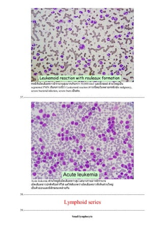 กรณีที่เม็ดเลือดขาวมีจํานวนสูงมากเกินกวา 50,000/mm3 และมีเซลลสวนใหญเปน
segmented PMN เรียกภาวะนี้วา Leukemoid reaction ภาวะนี้พบในหลายกรณีเชน malignancy,
severe bacterial infection, severe burn เปนตน
37.------------------------------------------------------------------------------------------------------------------
Acute leukemia สวนใหญมีเม็ดเลือดขาวสูง แตบางรายอาจมีจํานวน
เม็ดเลือดขาวปกติหรือตํ่าก็ไดแตใหสังเกตวาเม็ดเลือดขาวที่เห็นสวนใหญ
เปนตัวออนและมีลักษณะคลายกัน
38.------------------------------------------------------------------------------------------------------------------
Lymphoid series
39.------------------------------------------------------------------------------------------------------------------
Small lymphocyte
 