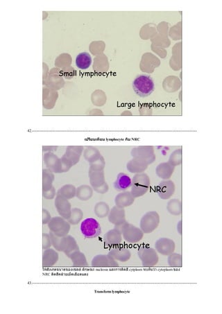 42.------------------------------------------------------------------------------------------------------------------
เปรียบเทียบ lymphocyte กับ NRC
ใหสังเกตขนาดของเซลลลักษณะ nucleous และการติดสีcytplasm จะเห็นวา cytoplasm ของ
NRC ติดสีคลายเม็ดเลือดแดง
43.------------------------------------------------------------------------------------------------------------------
Transform lymphocyte
 