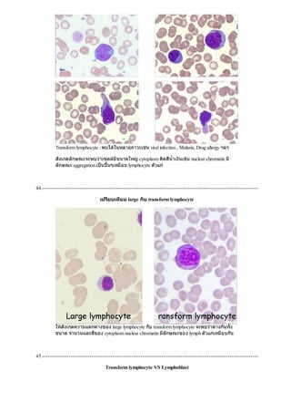Transform lymphocyte : พบไดในหลายภาวะเชน viral infection , Malaria, Drug allergy ฯลฯ
สังเกตลักษณะจะพบวาเซลลมีขนาดใหญcytoplasm ติดสีนํ้าเงินเขม nuclear chromatin มี
ลักษณะ aggregation เปนปนๆเหมือน lymphocyte ตัวแก
44.------------------------------------------------------------------------------------------------------------------
เปรียบเทียบ large กับ transform lymphocyte
ใหสังเกตความแตกตางของ large lymphocyte กับ transform lymphocyte จะพบวาตางกันทั้ง
ขนาด จํานวนและสีของ cytoplasm nuclear chromatin มีลักษณะของ lymph ตัวแกเหมือนกัน
45.------------------------------------------------------------------------------------------------------------------
Transform lymphocyte VS Lymphoblast
 