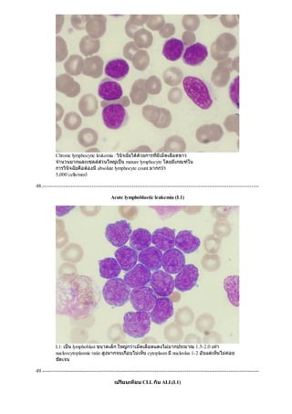 Chronic lymphocytic leukemia : วินิจฉัยไดดวยการที่มีเม็ดเลือดขาว
จํานวนมากและเซลลสวนใหญเปน mature lymphocyte โดยมีเกณฑใน
การวินิจฉัยคือตองมีabsolute lymphocyte count มากกวา
5,000 cells/mm3
48.------------------------------------------------------------------------------------------------------------------
Acute lymphoblastic leukemia (L1)
L1: เปน lymphoblast ขนาดเล็ก ใหญกวาเม็ดเลือดแดงไมมากประมาณ 1.5-2.0 เทา
nucleocytoplasmic ratio สูงมากจนเกือบไมเห็น cytoplasm มีnucleolus 1-2 อันแตเห็นไมคอย
ชัดเจน
49.------------------------------------------------------------------------------------------------------------------
เปรียบเทียบ CLL กับ ALL(L1)
 