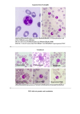Segmented form Neutrophils
เซลลระยะนี้เปนเซลลตัวแกของ nutrophils หรือเรียกอีกชื่อหนึ่ง วา Polymorphonuclear cells
(PMN) ใหสังเกต nucleus มีลักษณะ
เปน lobe หลาย lobe สวนเชื่อมตอแตละ lobe มีลักษณะเปนเสน ปกติมี
ประมาณ 3-4 lobe ถา nucleus ของ PMN มีตั้งแต5 lobe ขึ้นไปเรียกวา hypersegmented PMN
60.------------------------------------------------------------------------------------------------------------------
Granulocyte
เปรียบเทียบเซลลตระกูล granulocyte ในระยะตางๆกันตั้งแตระยะ ตัวออนสุดไปจนถึงตัวแก
61.------------------------------------------------------------------------------------------------------------------
PMN with toxic granules and vacuolization
 
