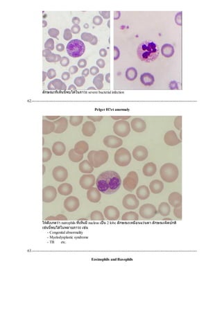 ลักษณะที่เห็นนี้พบไดในภาวะ severe bacterial infection
62.------------------------------------------------------------------------------------------------------------------
Pelger H?et anormaly
ใหสังเกตวา nutrophils ที่เห็นมีnucleus เปน 2 lobe ลักษณะเหมือนแวนตา ลักษณะผิดปกติ
เชนนี้พบไดในหลายภาวะ เชน
- Congenital abnormality
- Myelodysplastic syndrome
- TB etc.
63.------------------------------------------------------------------------------------------------------------------
Eosinophils and Basophils
 
