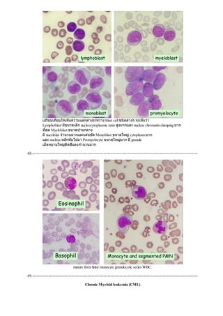 เปรียบเทียบใหเห็นความแตกตางระหวาง blast cell ชนิดตางๆ จะเห็นวา
Lymphoblast มีขนาดเล็ก nucleocytoplasmic ratio สูงมากและ nuclear chromatin clumping มาก
ที่สุด Myeloblast ขนาดปานกลาง
มีnucelolus จํานวนมากและเดนชัด Monoblast ขนาดใหญcytoplasm มาก
และ nucleus หยักพับไปมา Promyelocyte ขนาดใหญมาก มีgranule
เม็ดหยาบใหญติดสีแดงจํานวนมาก
68.------------------------------------------------------------------------------------------------------------------
mature form ของ monocyte granulocytic series WBC.
69.------------------------------------------------------------------------------------------------------------------
Chronic Myeloid leukemia (CML)
 