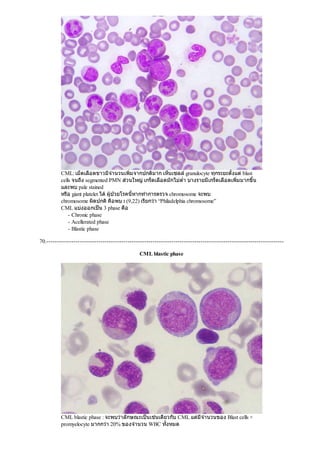 CML: เม็ดเลือดขาวมีจํานวนเพิ่มจากปกติมาก เห็นเซลลgranulocyte ทุกระยะตั้งแตblast
cells จนถึง segmented PMN สวนใหญเกร็ดเลือดมักไมตํ่า บางรายมีเกร็ดเลือดเพิ่มมากขึ้น
และพบ pale stained
หรือ giant platelet ไดผูปวยโรคนี้หากทําการตรวจ chromosome จะพบ
chromosome ผิดปกติคือพบ t (9,22) เรียกวา “Philadelphia chromosome”
CML แบงออกเปน 3 phase คือ
- Chronic phase
- Acellerated phase
- Blastic phase
70.------------------------------------------------------------------------------------------------------------------
CML blastic phase
CML blastic phase : จะพบวาลักษณะเปนเชนเดียวกับ CML แตมีจํานวนของ Blast cells +
promyelocyte มากกวา 20% ของจํานวน WBC ทั้งหมด
 